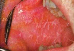 Ο ομαλός λειχήνας του στόματος και η ολιστική - Ομοιοπαθητική θεραπευτική του αντιμετώπιση